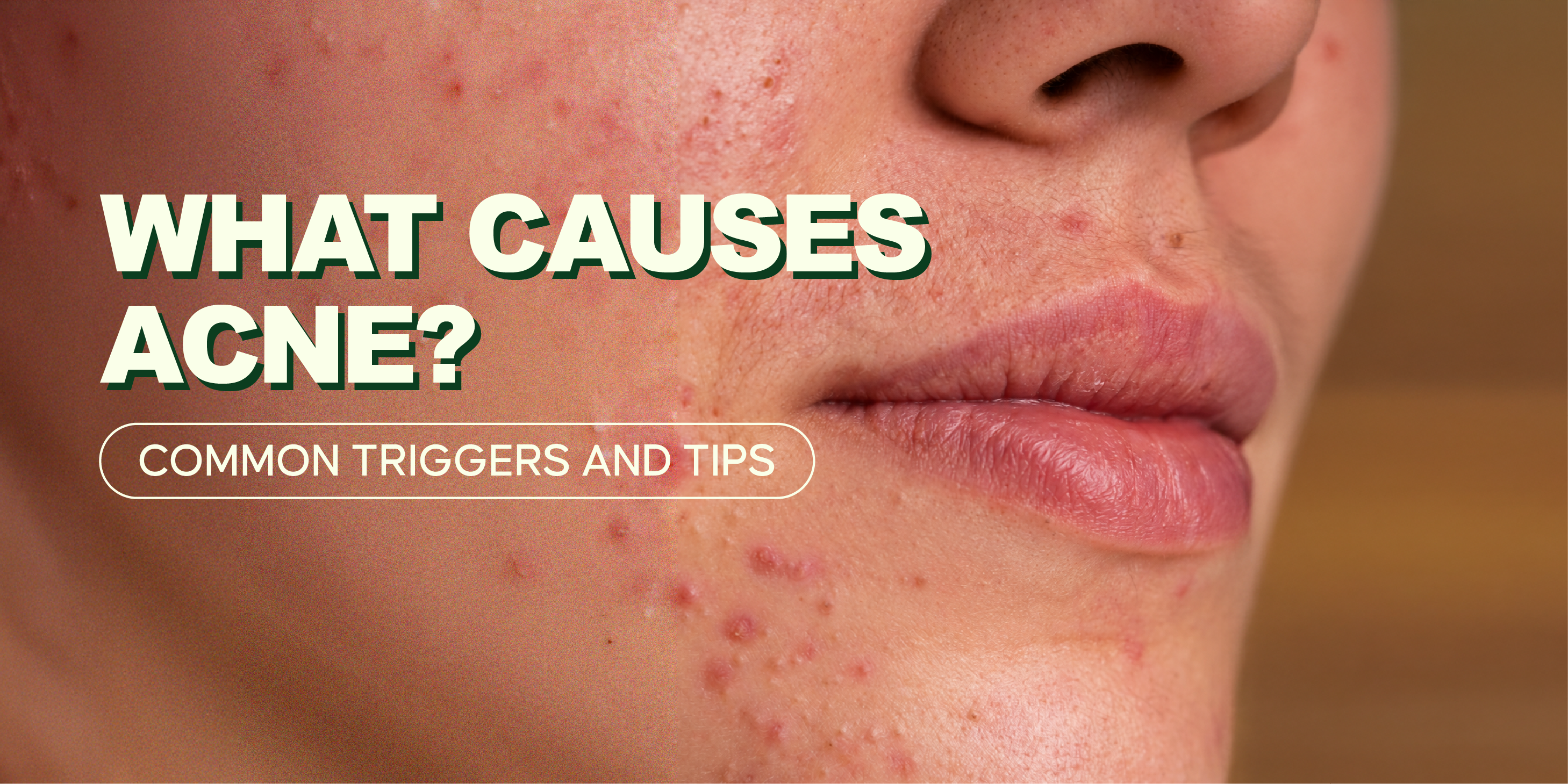 Explore common acne triggers and practical skincare tips to help reduce their impact, manage breakouts, and maintain healthier-looking skin. 