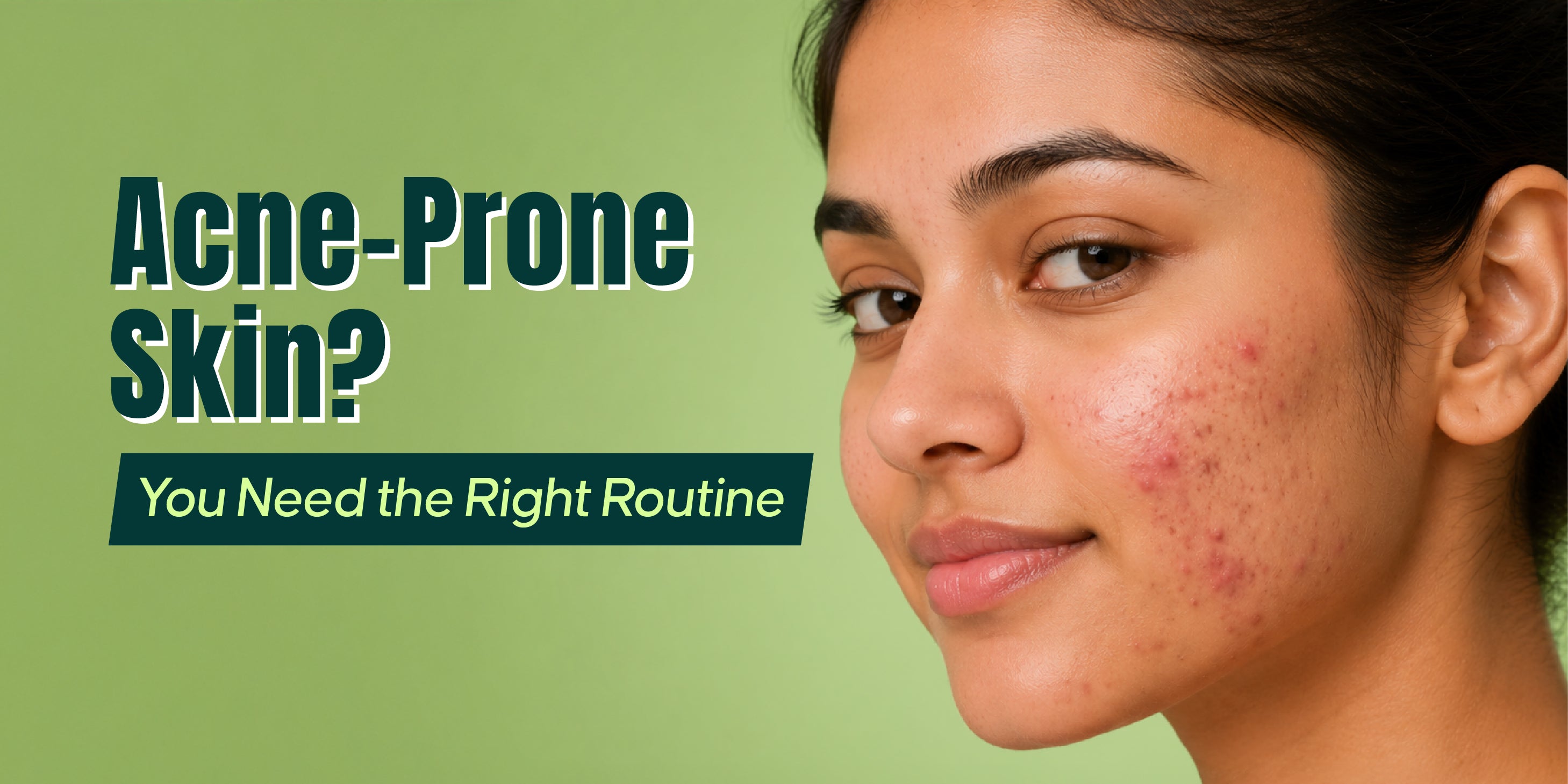 Why Acne-Prone Skin Needs the Right Face Care Routine
