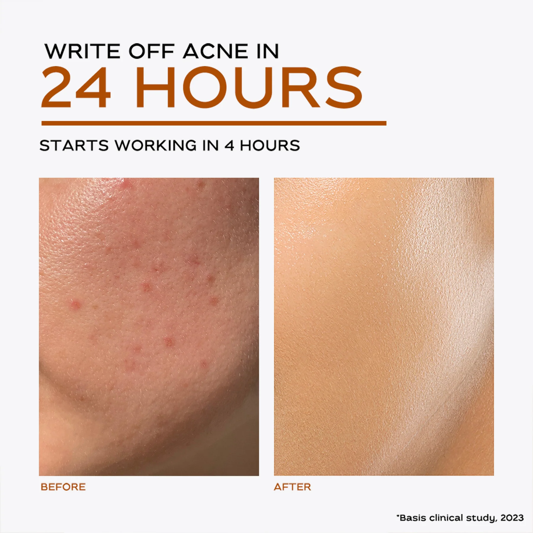 Acne Clear+ Treatment Pen